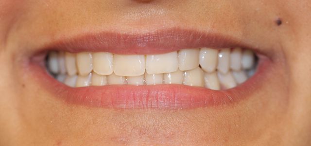 Behandlung mit fester Zahnspange