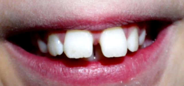 Behandlung mit herausnehmbarer Zahnspange