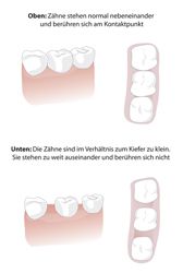 Zahnlücken im Bereich der Backenzähne