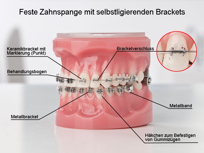 Selbstligierende Brackets - Kieferorthopäde Leimen, Dr. Ullrich