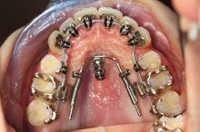 Rhodium-Brackets