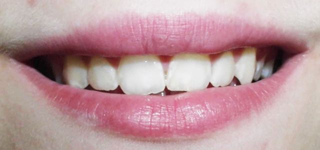 Behandlung mit herausnehmbarer Zahnspange