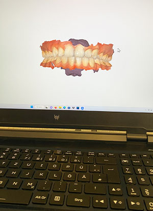 Digitaler Zahnscan und 3D-Drucker 2