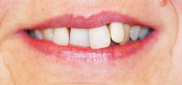 Behandlung mit fester Zahnspange